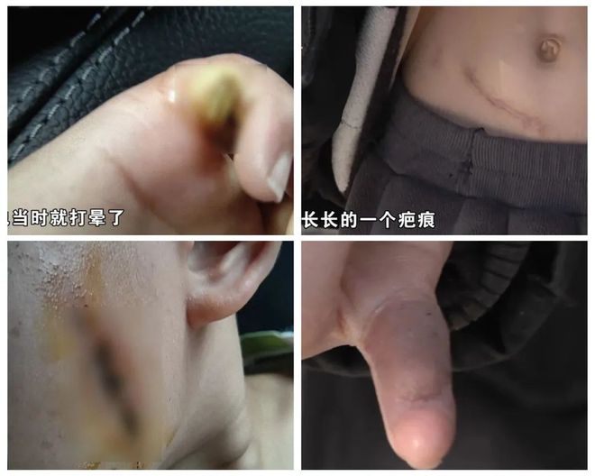 ！5岁儿童爬空调外机瞬间晕厥！凯时尊龙最新网站肌腱都打断了(图7)